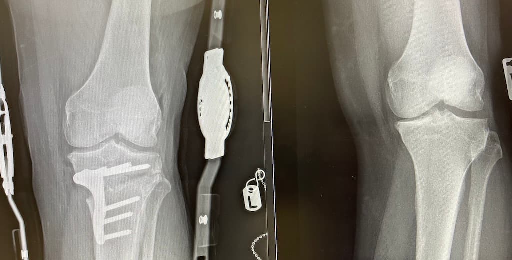 Post-replacement knee x-ray showing metal implant